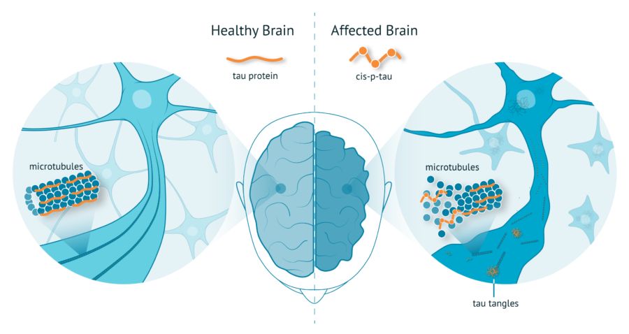 Healthy brain vs Affected Brain